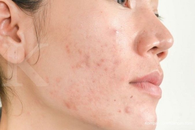 Kulit Wajah Kaku Setelah Pakai Obat Jerawatan Review