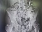 IMG-20260409-WA0028 Hasil foto Rontgen MVA. (Ist)